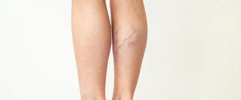 Jakie leki na zakrzepicę nóg? Najlepsze opcje i ważne ostrzeżenia